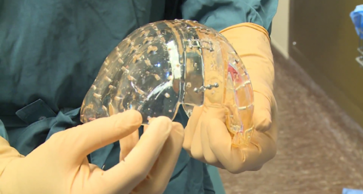 Woman Has Skull Replaced With 3D Printed Implant