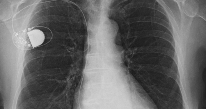 Body Hack: IoT Medical Devices Are Vulnerable